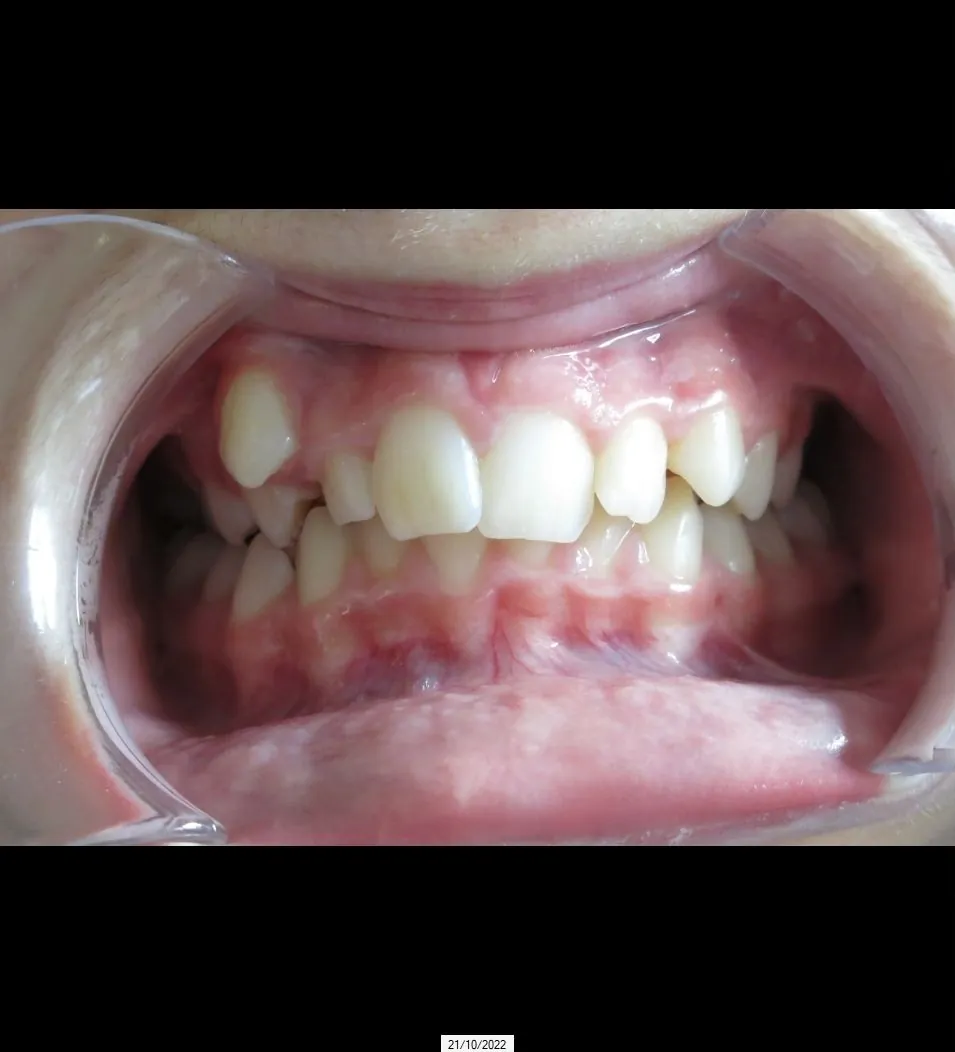 Avant traitement : malocclusion sévère de classe II — cabinet du Dr Baron à Challans