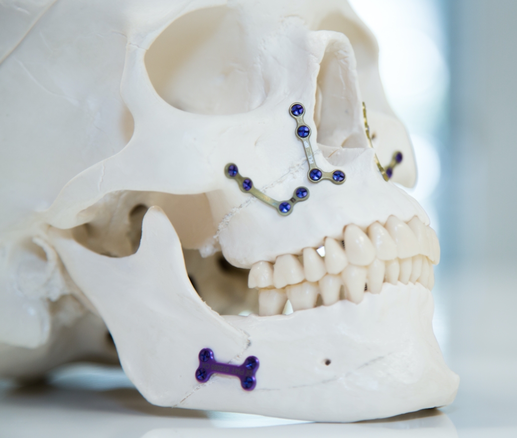 Traitement ortho-chirurgical : repositionnement des bases osseuses