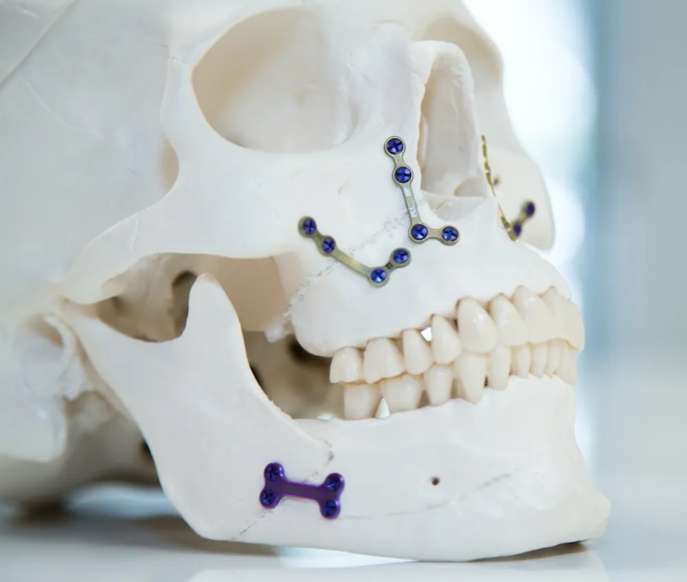Traitement ortho-chirurgical : repositionnement des bases osseuses