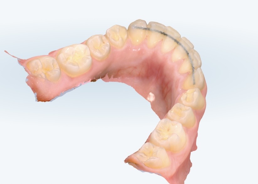 Fil de contention collé derrière les dents