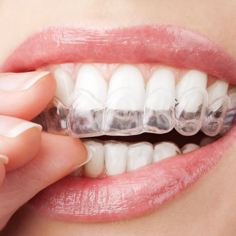 Mise en place d'un aligneur transparent Invisalign