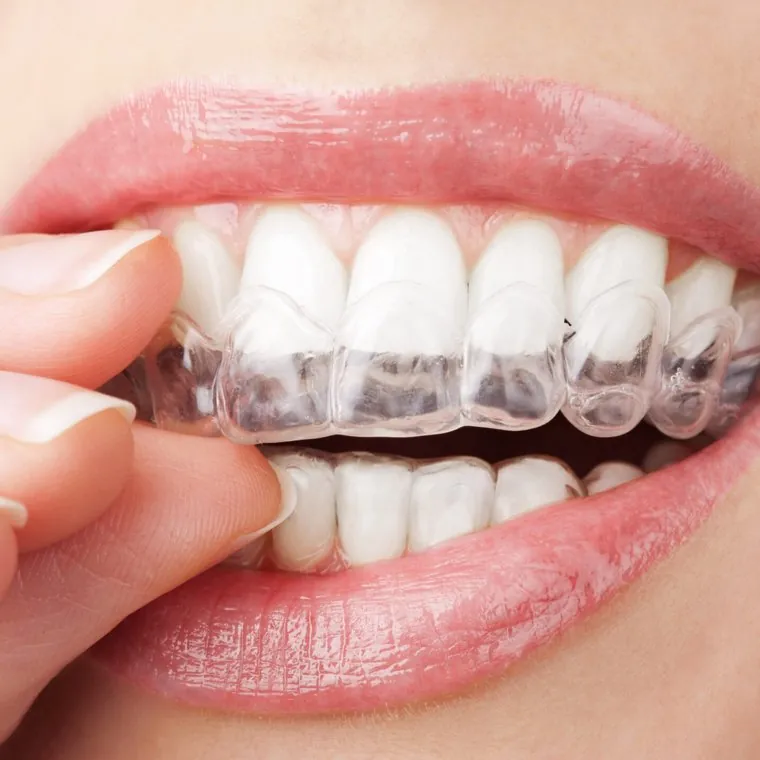 Mise en place d'un aligneur transparent Invisalign